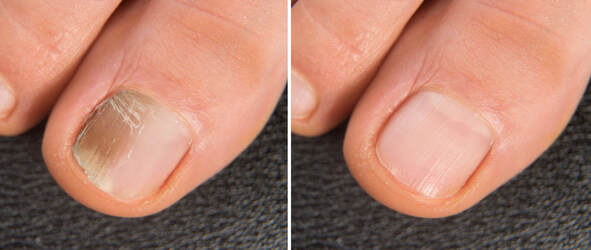 Fungal Nails - THE FOOT FIXERS